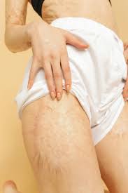 Cellulite Before And After Weight Loss
